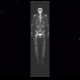 Osteolytic changes of femur: NM - Nuclear medicine